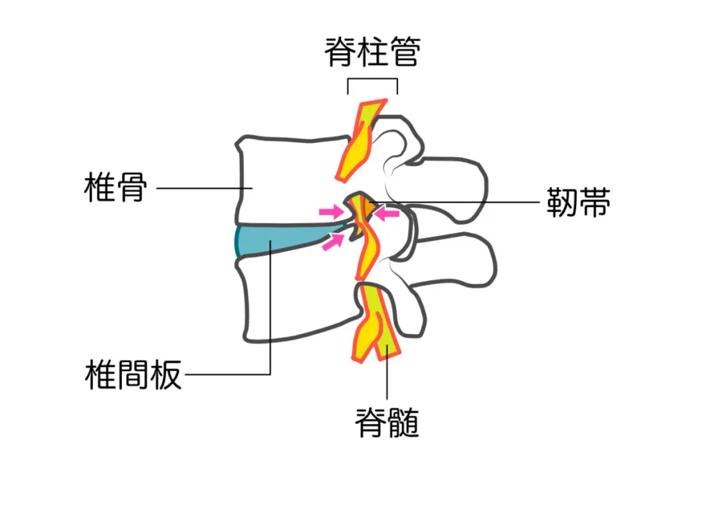 50代女性必見の脊柱管狭窄症からくる坐骨神経の痛み対策 | こばやし